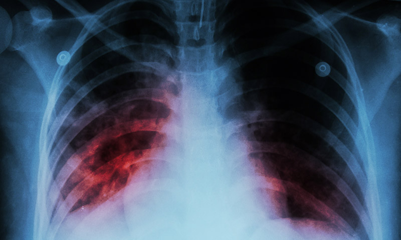 tuberculosis-chest-x-ray.jpg